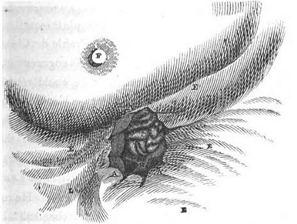 a medical illustration of a hole in a man's stomach