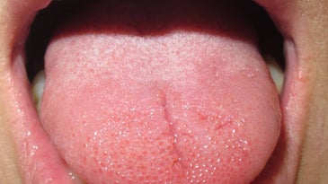 This strange condition could explain why your tongue feels weird