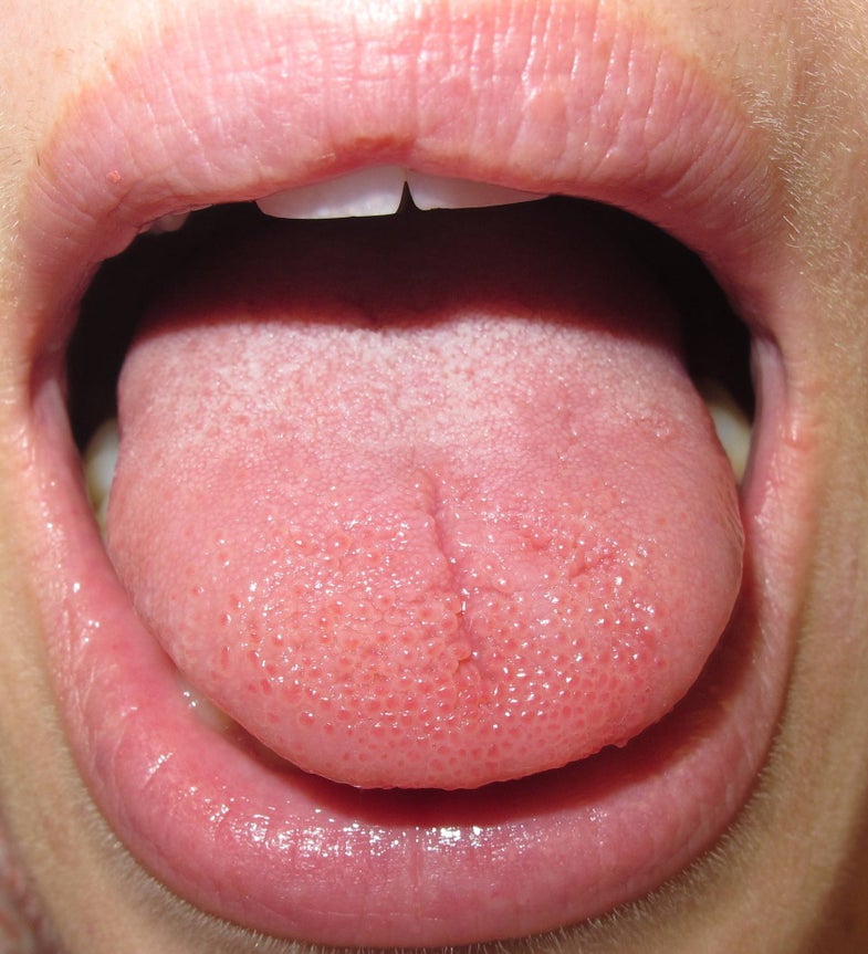 The tongue of a patient with burning mouth syndrome, which looks much like that of a person without the condition.