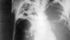 Extensively Drug Resistant Tuberculosis
