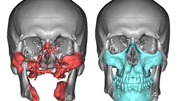 How 3D technology is revolutionizing face transplants
