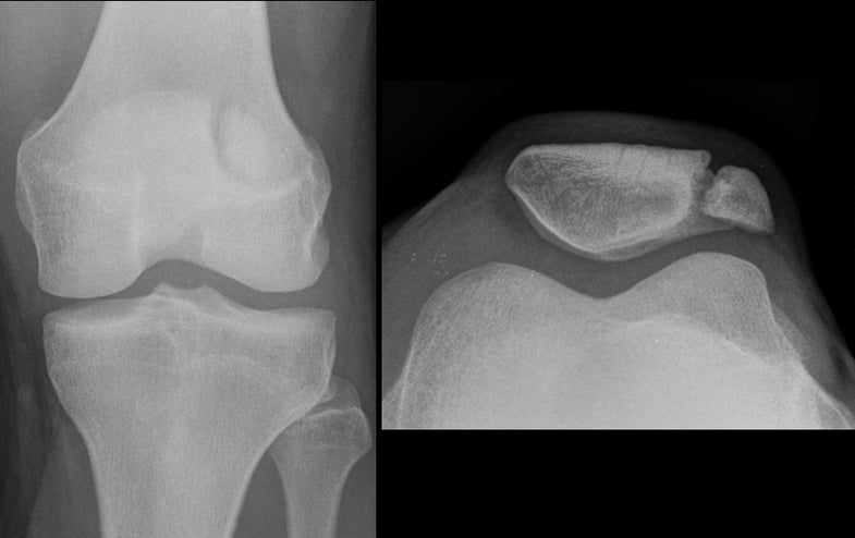 A patella, or kneecap, seen from the front and side of the leg