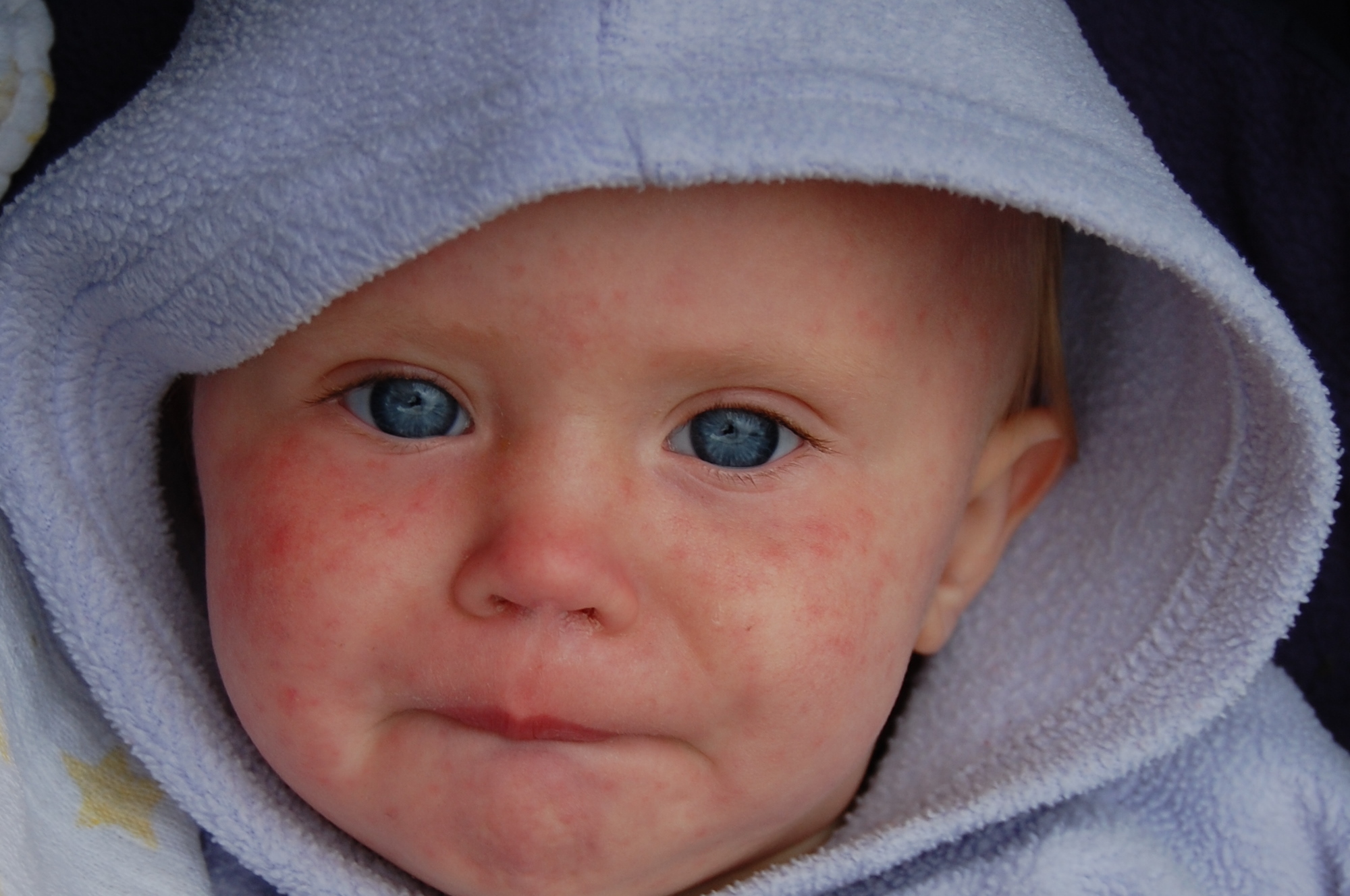 1 in 4 kindergartners aren’t fully vaccinated in county with measles outbreak