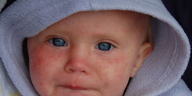 1 in 4 kindergartners aren’t fully vaccinated in county with measles outbreak