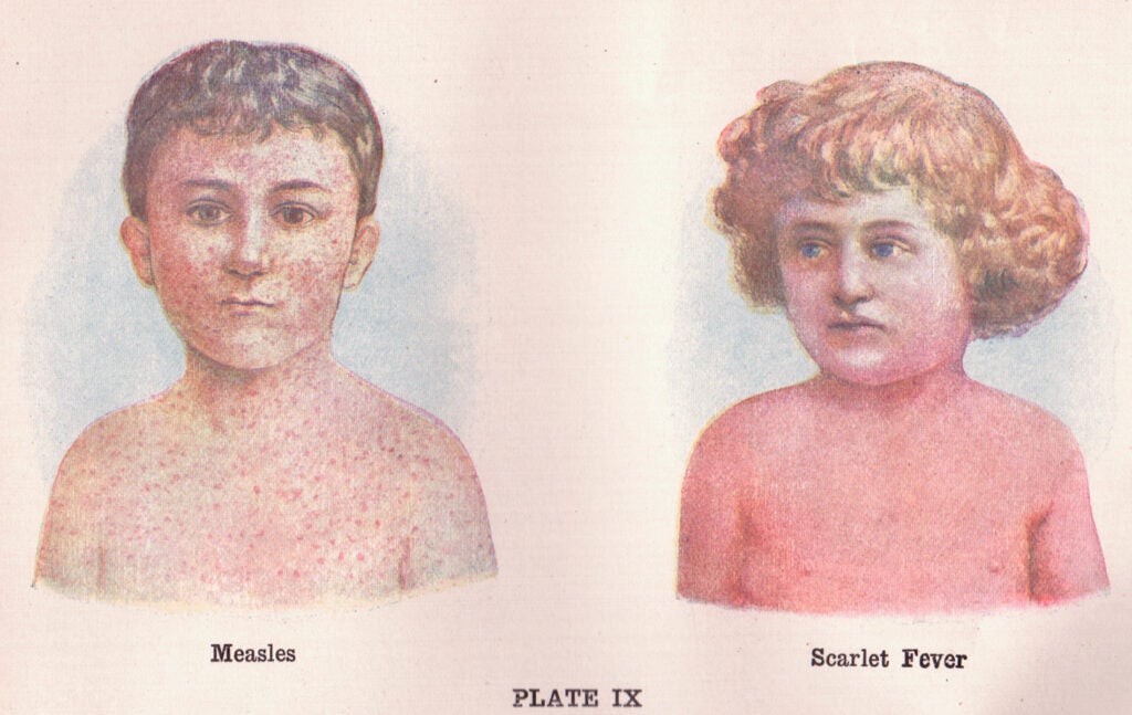 measles scarlet fever historical