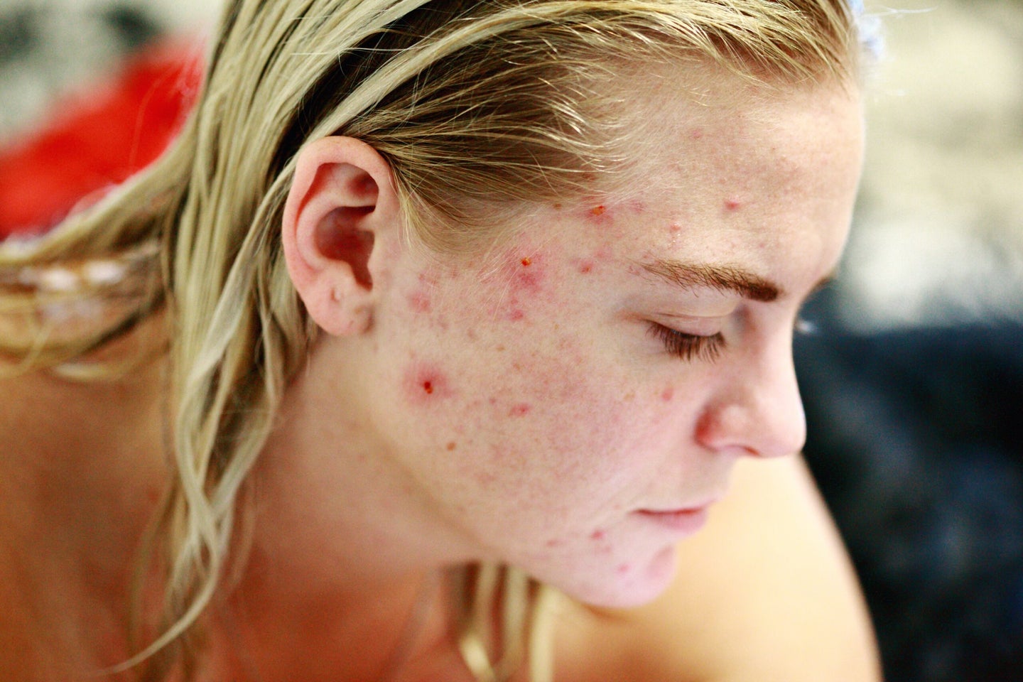 acne pimple zit human skin