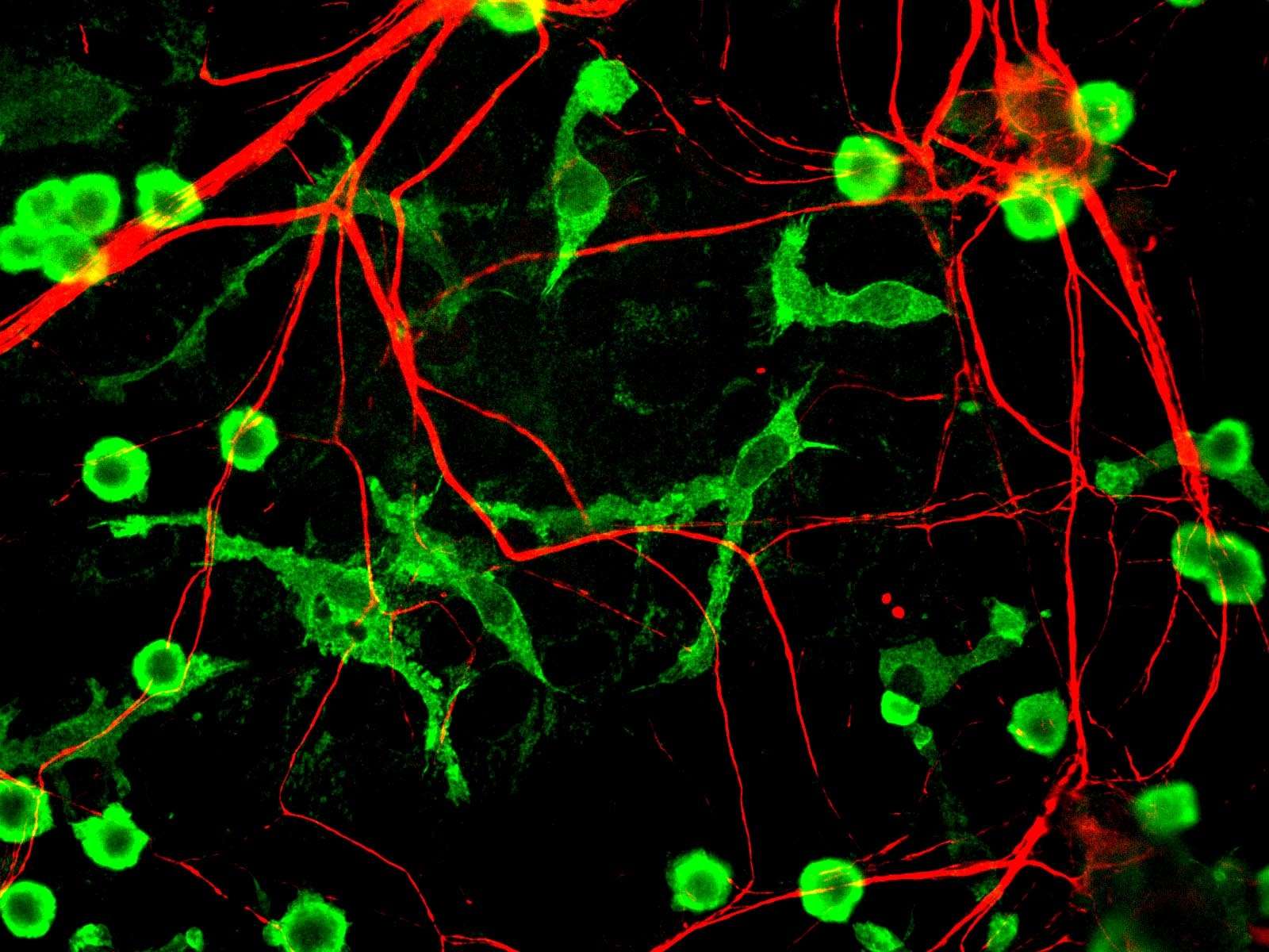 Could An Overactive Immune System Cause Schizophrenia?