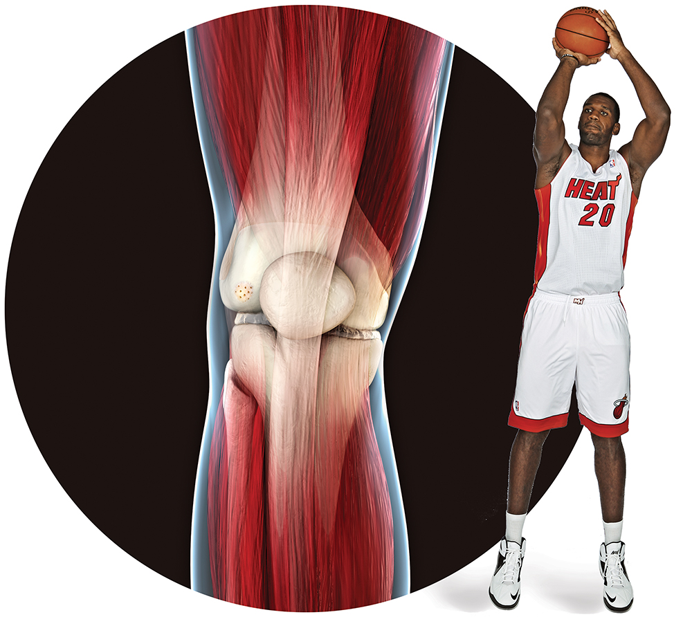 Building Better Knees For The NBA