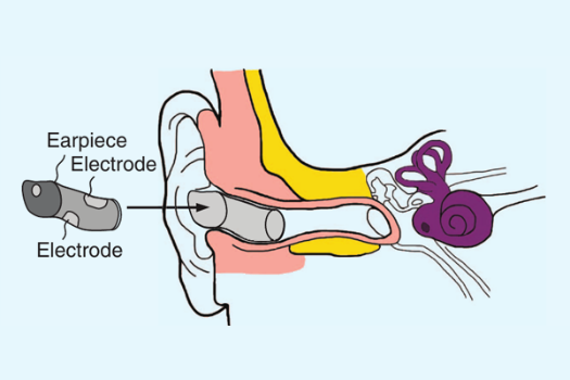 An In-Ear Brain Monitor Could Watch For Seizures Discreetly