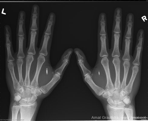RFID Implant In X-Rays