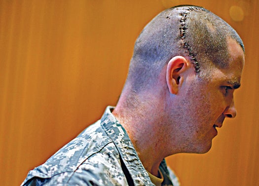 WASHINGTON - FEBRUARY 01: U.S. Army Staff Sergeant Jeremy Murphy wears a scar from his injury on his head after just being presented with a Purple Heart during a ceremony at Walter Reed Medical Center February 1, 2008 in Washington, DC. Staff Sergeant Murphy was awarded the medal after he recieved a bullet wound in his head while on tour in Iraq. (Photo by Mark Wilson/Getty Images) *** Local Caption *** Jeremy Murphy
