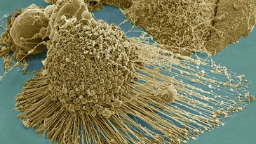 A HeLa undergoing apoptosis, or cell death, under a scanning electron microscope