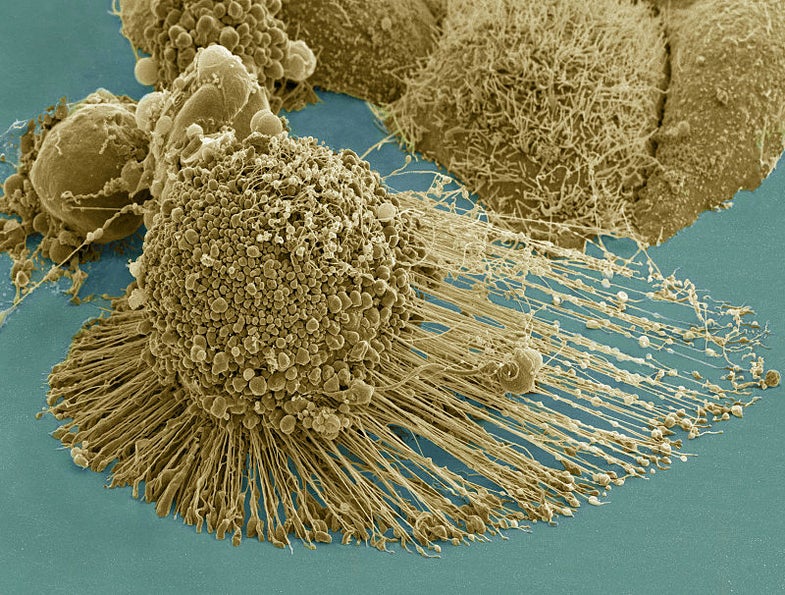 A HeLa undergoing apoptosis, or cell death, under a scanning electron microscope