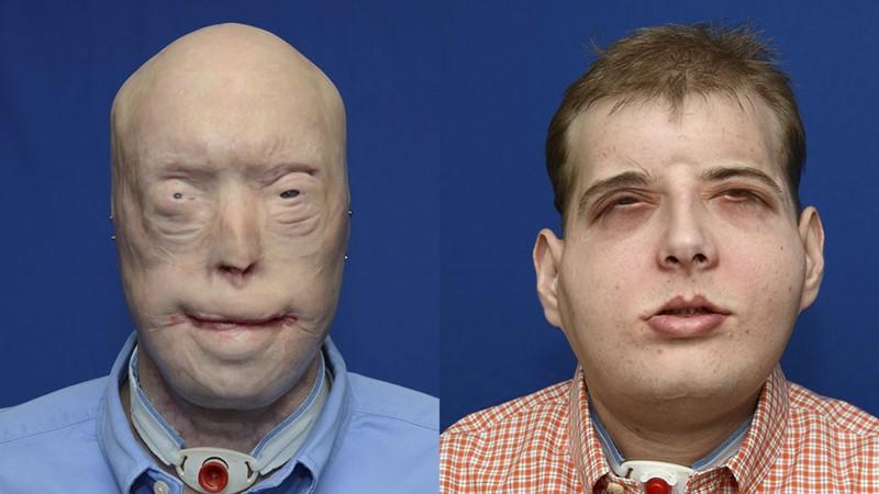A Mississippi firefighter who was injured during a rescue just spent 26 hours undergoing a <a href="http://gizmodo.com/behold-the-most-extensive-face-transplant-in-medical-hi-1742994282">facial transplantation surgery</a>. A 150-person medical team performed the world's most extensive face transplant, giving Patrick Hardison a new scalp, ears, nose, lips, and eyelids, finally allowing him to blink.