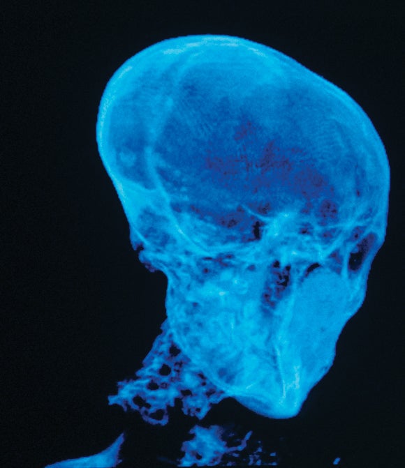 A CT scan of the skull of King Tut, who may have been his son, shows the same abnormal head shape.