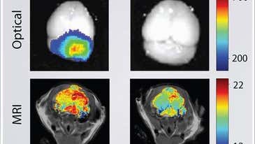 Scientists Paint Brain Tumors With Nanoparticles for More Precise Removal