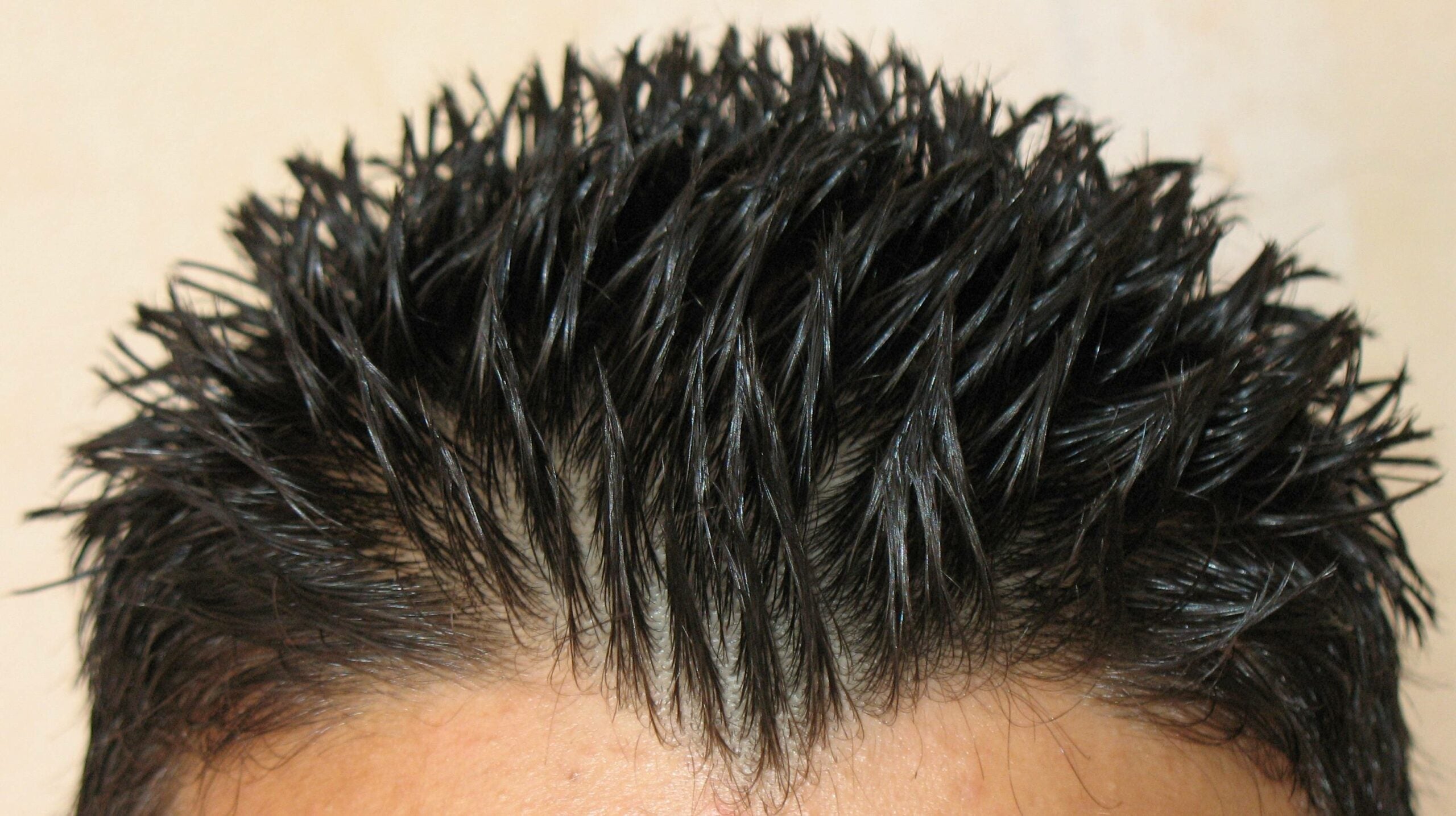 The Bacteria On Your Scalp Could Be Key To Fighting Dandruff