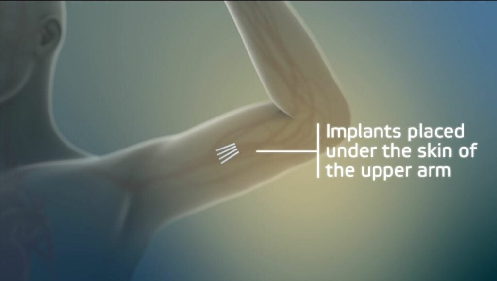 The Probuphine implant is inserted just below the skin in the upper arm