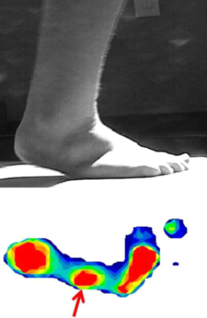 The most extreme example of a chimp-like midtarsal break found in the gaits of 398 subjects.