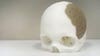 3-D-Printed Implant Replaces 75 Percent Of Man&#8217;s Skull