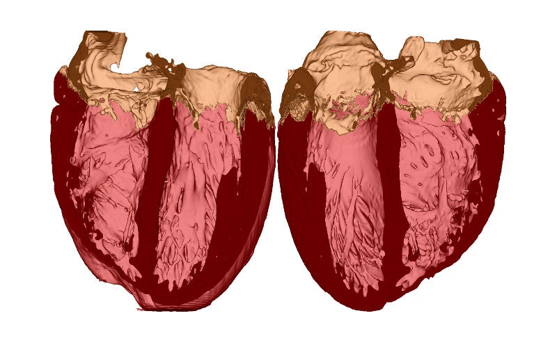 A 3-D model of a patient's heart shows unique characteristics like scar tissue to study personal ailments. With these virtual organs, doctors can make more informed diagnoses and improve treatment of heart diseases. A 3-D model is made by merging MRI scans with image processing tools.
