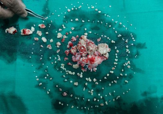 This week, doctors in Mumbai, India operated on 17-year-old Ashik Gavai. Over the course of seven hours, the doctors removed 232 extra teeth from Gavai's mouth, sometimes using a chisel and hammer. The culprit behind this cornucopia of teeth is a complex compound odontoma, which is similar to the bump that grows when someone has an unerupted tooth. Except this one was way, way bigger. "It's a sort of benign tumor," the doctors told the BBC, where one gum creates many teeth.