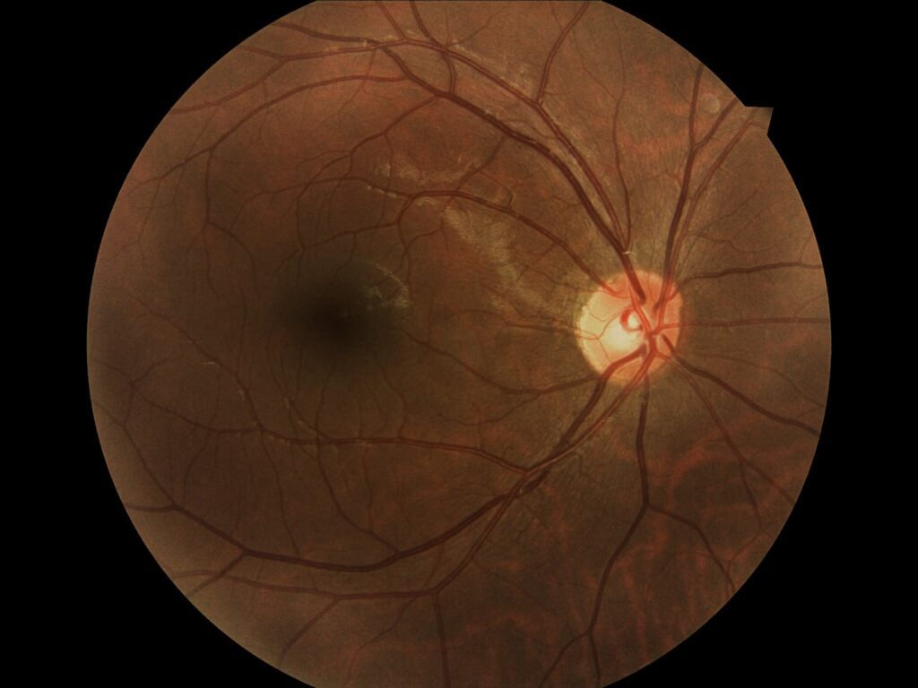 I recently went to see my optometrist and he used a special machine to take a “fundus photograph” of my eyes. The fundus camera takes a picture of the back of the eye to test for retinal detachment or eye diseases such as glaucoma. The dark area is my macula, the part of the eye that gives the most visual sharpness, and the bright light is shinning on my optic disk. Don’t worry, my eyes are fine.