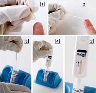 A lancet draws a blood droplet (1), which is scooped up by a plastic specimen loop (2). the sample is mixed with a developing solution (3). A test-reading device is dipped into the viAL and sits for 20 minutes (4). a single pink line at the control area (c) means the test is negative (5).