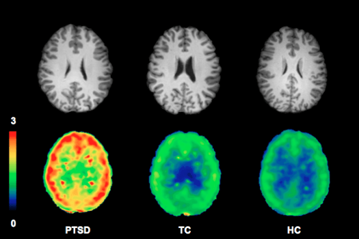A Cannabinoid That Looks Like THC Could Be Key To Diagnosing PTSD