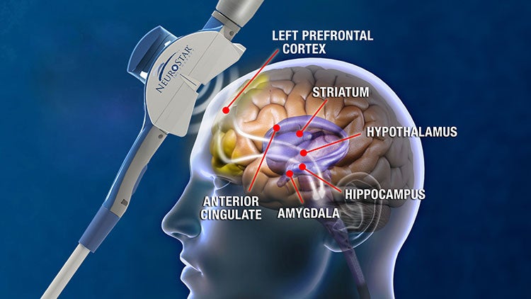 A schematic showing how TMS stimulates the left prefrontal cortex, activating areas deeper in the brain.