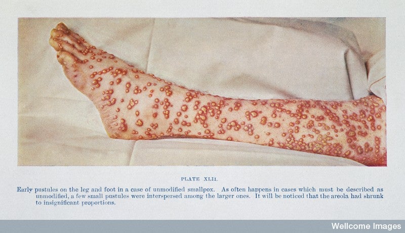 L0032956 Early pustules of smallpox
Credit: Wellcome Library, London. Wellcome Images
images@wellcome.ac.uk
http://wellcomeimages.org
WC585 1908R53d
"The Diagnosis of Smallpox", Ricketts, T. F,
Casell and Company, 1908
Plate XLII, Early pustules on the leg and foot in
a case of unmodified smallpox.
Published:  - 

Copyrighted work available under Creative Commons Attribution only licence CC BY 4.0 http://creativecommons.org/licenses/by/4.0/