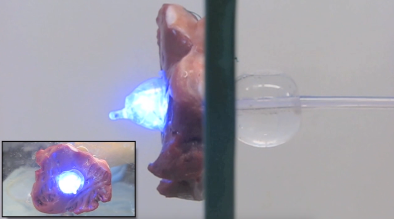 UV Light And Balloons Can Plug Holes In Your Heart Or Other Organs