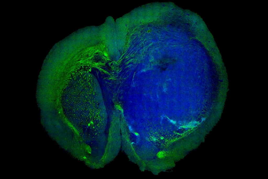 With SRS microscopy, the tumor appears blue, while normal tissue shows up green.