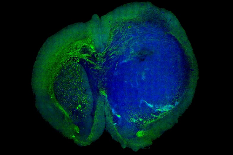 With SRS microscopy, the tumor appears blue, while normal tissue shows up green.