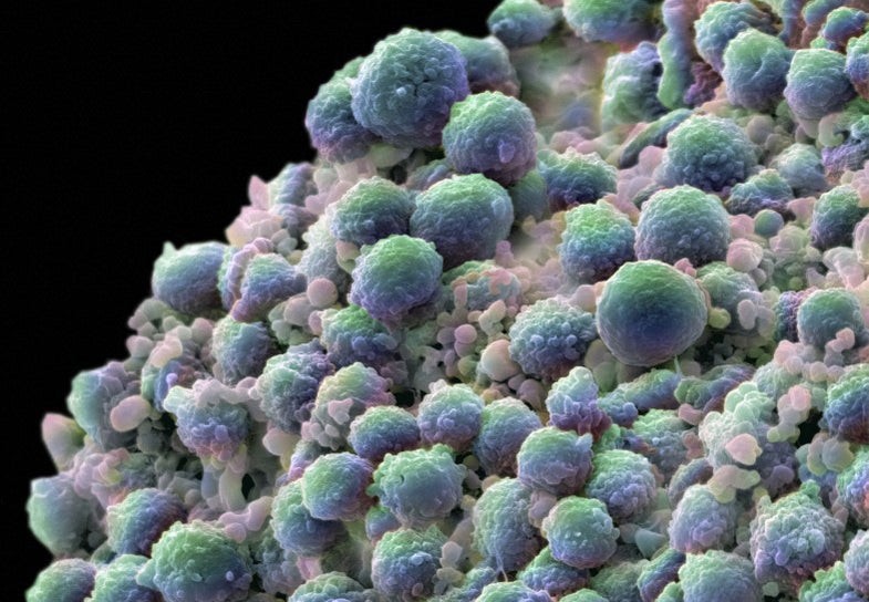 Color-enhanced image of prostate cancer cells.