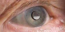 FDA Approves First Telescopic Eye Implant to Treat Blindness