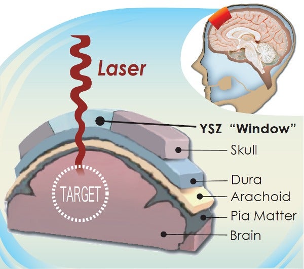Clear Cranial Implant Lets Doctors See Into The Brain