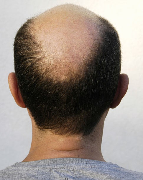Cloning Hair to Fight Baldness