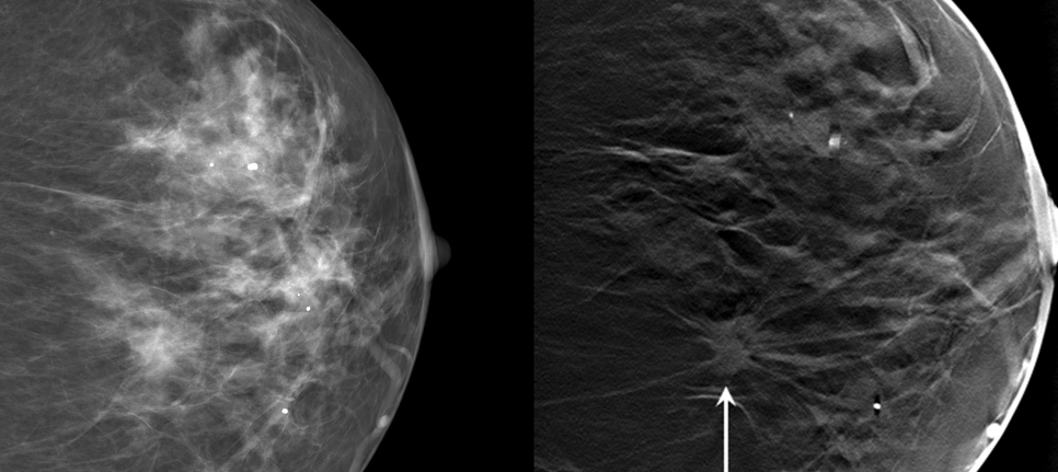 Digital breast tomosynthesis, or tomography, gives doctors a 3D look at a breast, making it easier to catch pre-cancerous growths.