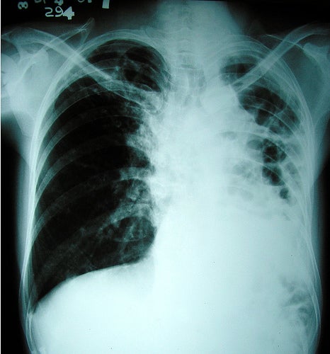 Highest Levels Yet of Highly-Resistant TB CASES