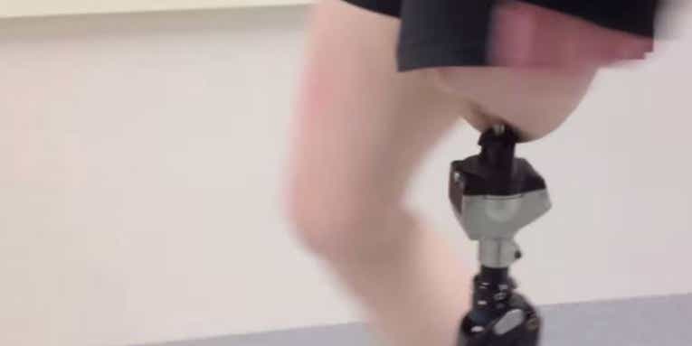 Approved: Prosthetic Legs That Anchor Directly To The Bone