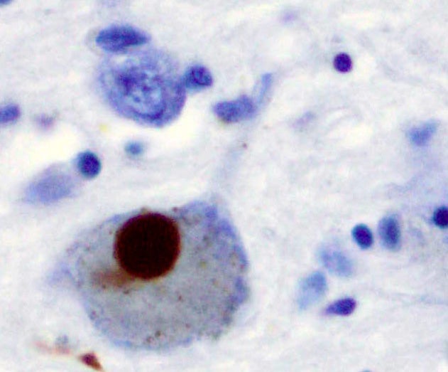 The brownish area is a Lewy body, an abnormal protein chunk that develops inside brain cells in Parkinson's disease.