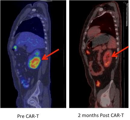 These two PET scans show a lymphoma patient before receiving the CAR-T cell treatment, left, and afterward, right. The arrow indicates a cancerous mass on the patient's kidney that almost totally disappeared two months after receiving the treatment.