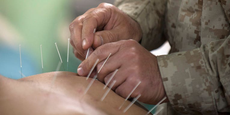 Acupuncture May Work Like Drugs To Relieve Stress
