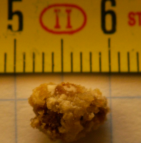 A (large) kidney stone, measuring about 0.3 inches in diameter.
