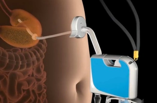 Segway Inventor Patents A Gadget That Sucks Food Directly Out Through A Port In Your Stomach