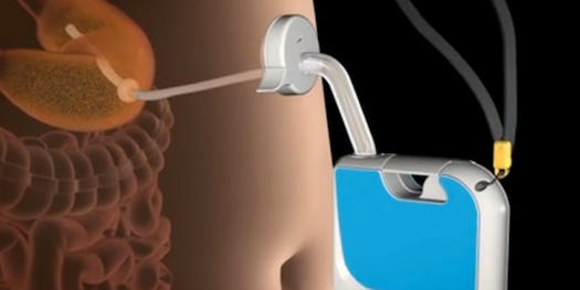 Segway Inventor Patents A Gadget That Sucks Food Directly Out Through A Port In Your Stomach