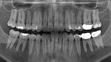 The End Of Root Canals?