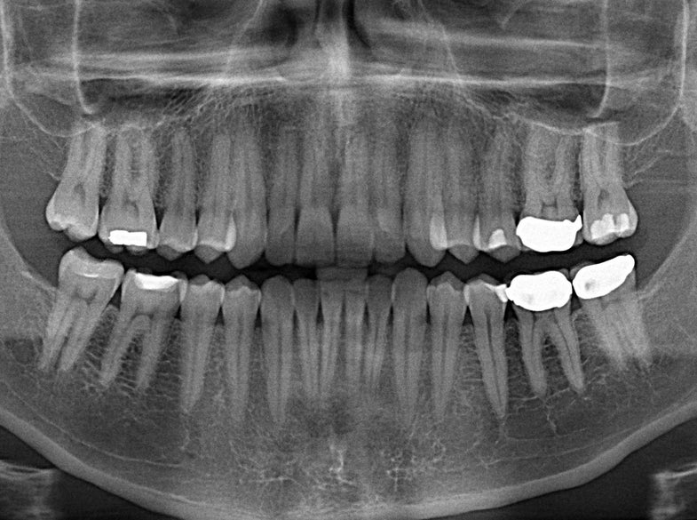 Visited the dentist today. Here was my x-ray. This was the first time I used this machine that I put my head into and it rotated around my head.