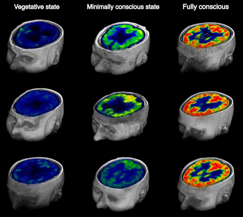 FDG-PET image of healthy and brains of varying consciousness
